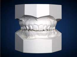 gipsani modeli za ortodontsku analizu