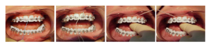 Upotreba konca za zube sa fiksnom protezom